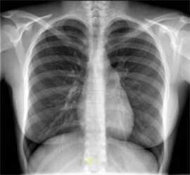 rx-torax-do outro mundo